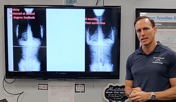scoliosis corrected in child with chiropractic